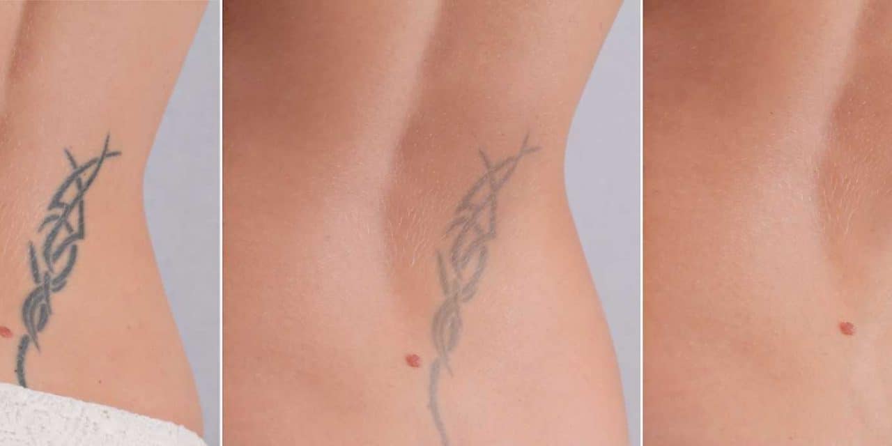 удаление тату ремувером на спине