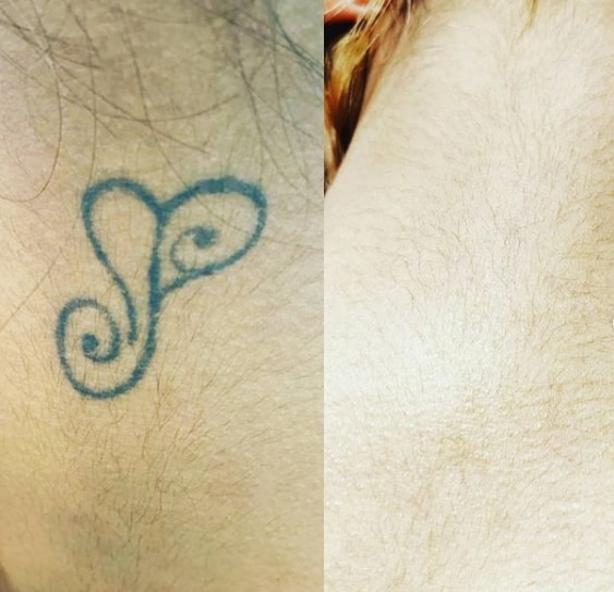 удаление тату ремувером на шее