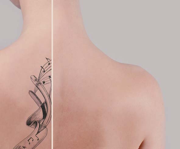 удаление тату ремувером спина