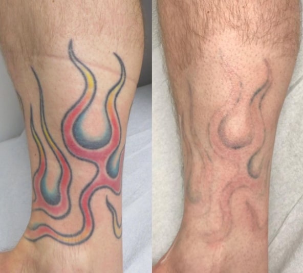 удаление цветного тату ремувером