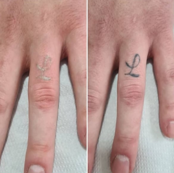 удаление тату ремувером на пальце