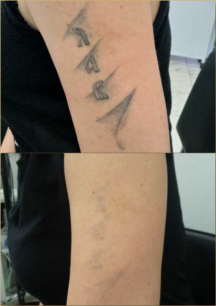 удаление тату ремувером на плече