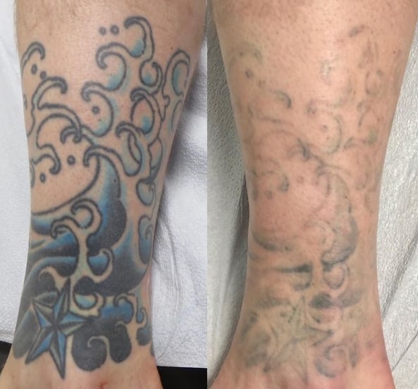 удаление тату ремувером на ноге