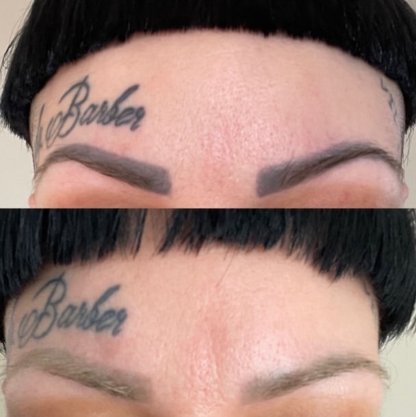 удаление татуажа темных бровей