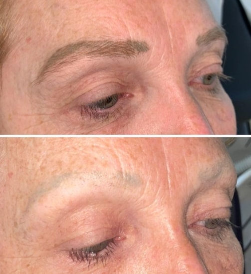 удаление перманентного макияжа бровей