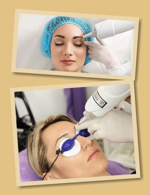 видалення татуажу брів