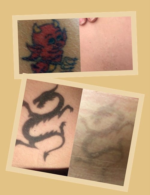 як виводять наколки