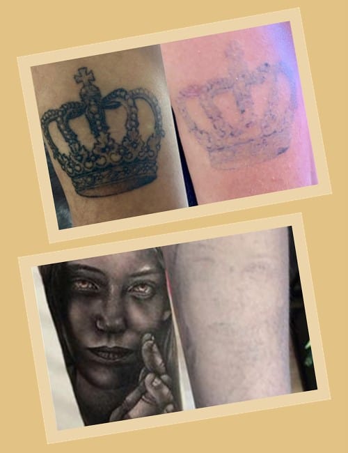 для повного видалення тату потрібно 3-7 сеансів