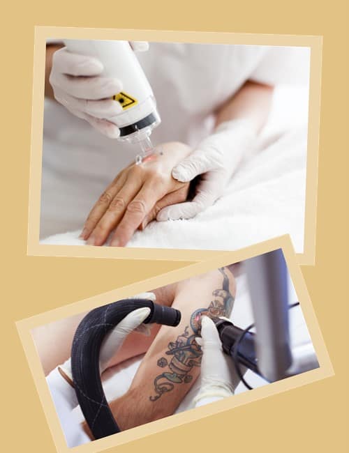 Методи видалення татуювань