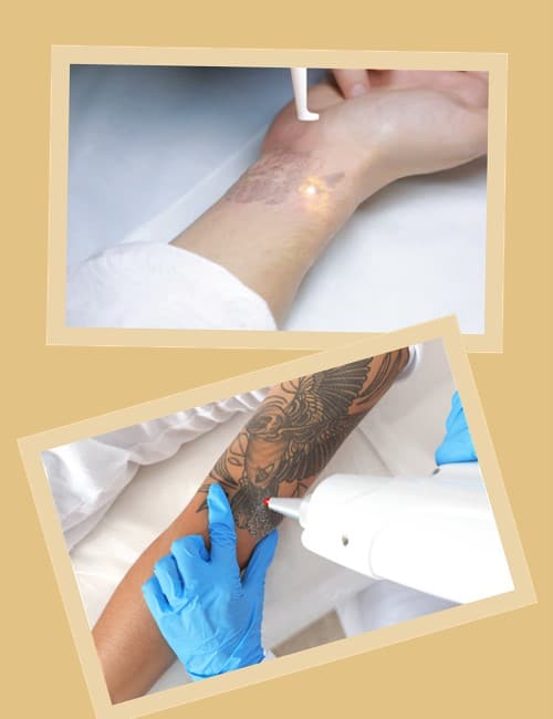 лазер впливає тільки на пігмент