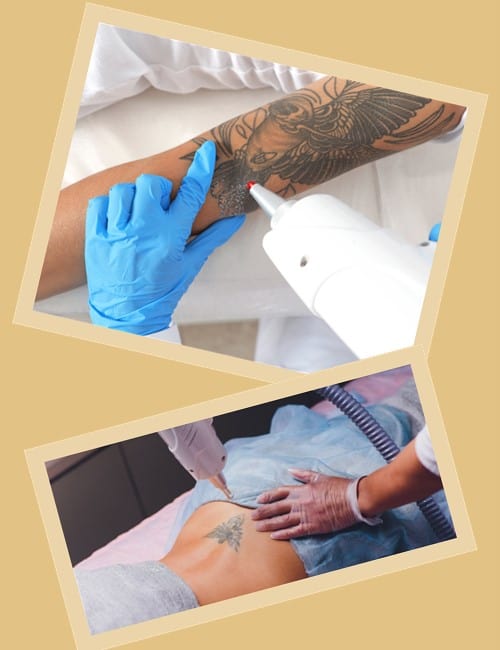 Методи видалення тату