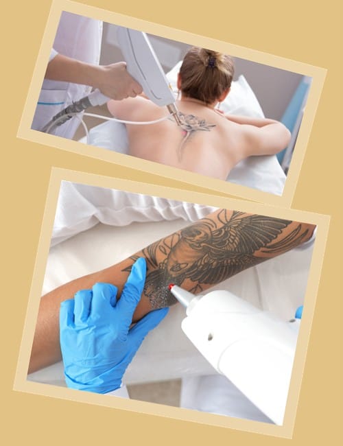 зводити тату лазером