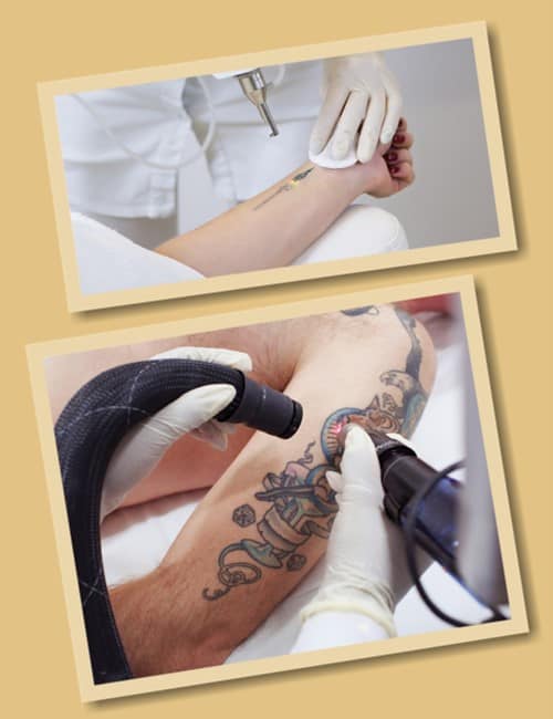 как удалит татуировку