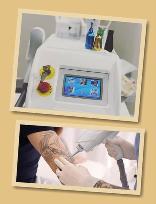 Зведення татуювань лазером