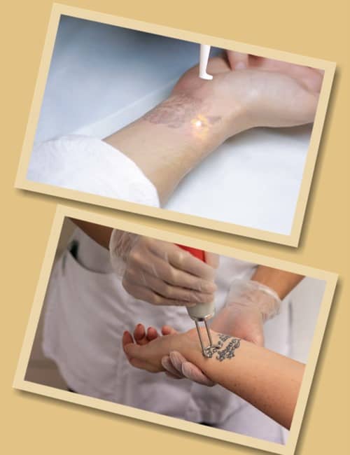 Як зводять татуювання лазером