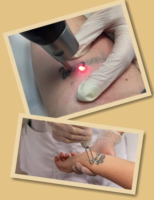 видалити старе тату