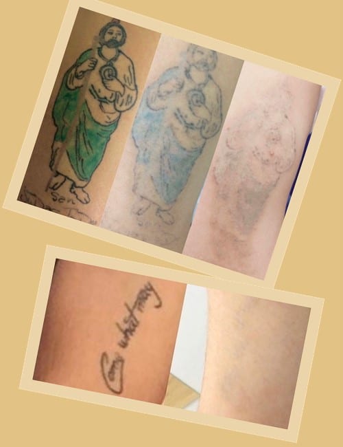 Ціна зведення тату лазером