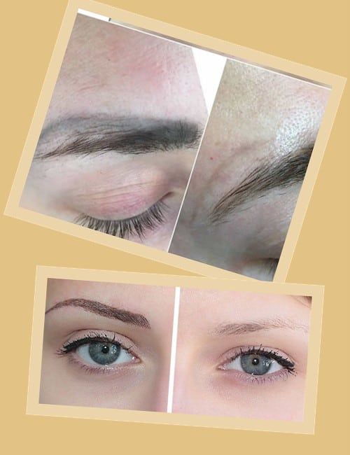 після видалення татуажу лазером