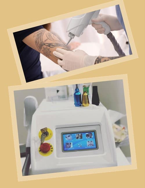 Протипоказання до лазерного видалення тату