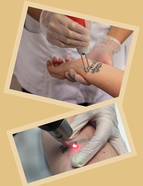 Чому лазерне виведення – найкраще