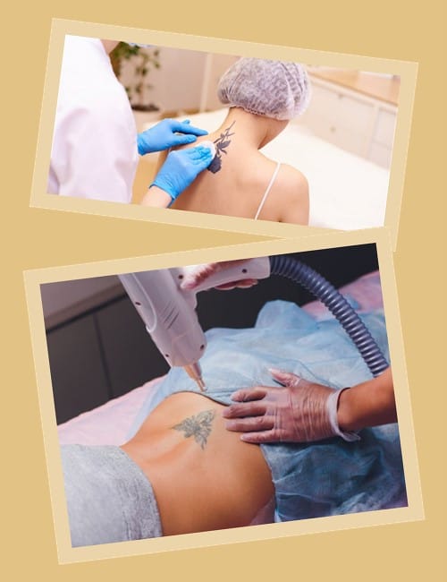 Від чого залежить ефективність та швидкість видалення татуювання