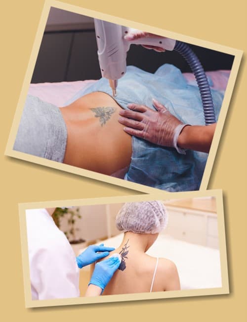 Методи видалення татуювань