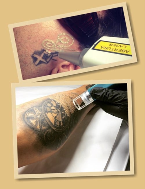 Процес зведення татуювань лазером