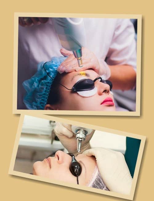 Видалення татуаж брів за допомогою лазера