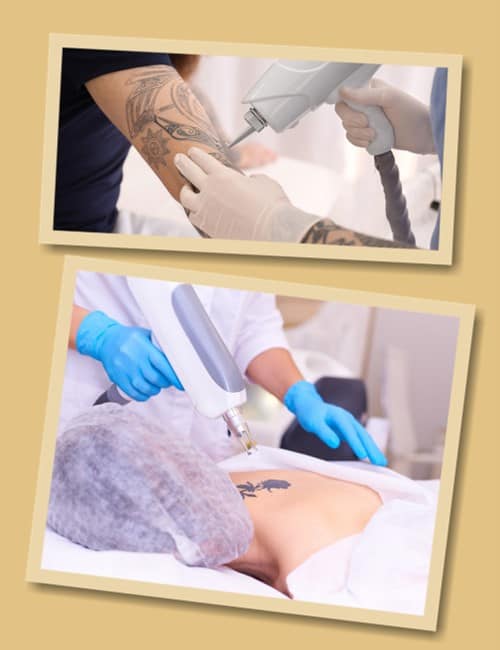 Виведення тату лазером