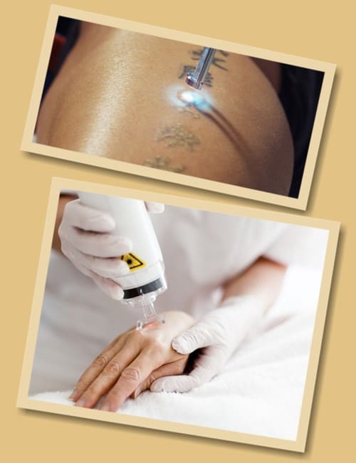 лазерне видалення тату