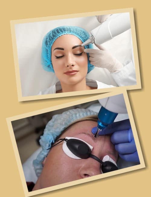 лазерне видалення татуажу