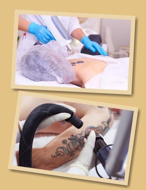 Переваги лазерного видалення тату