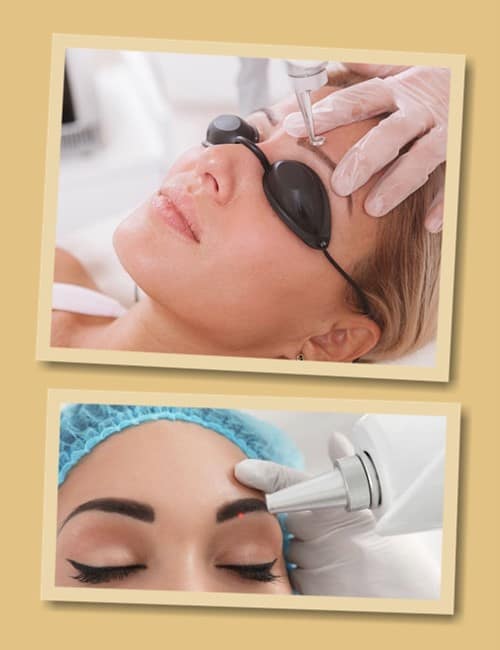 Процес видалення татуажу