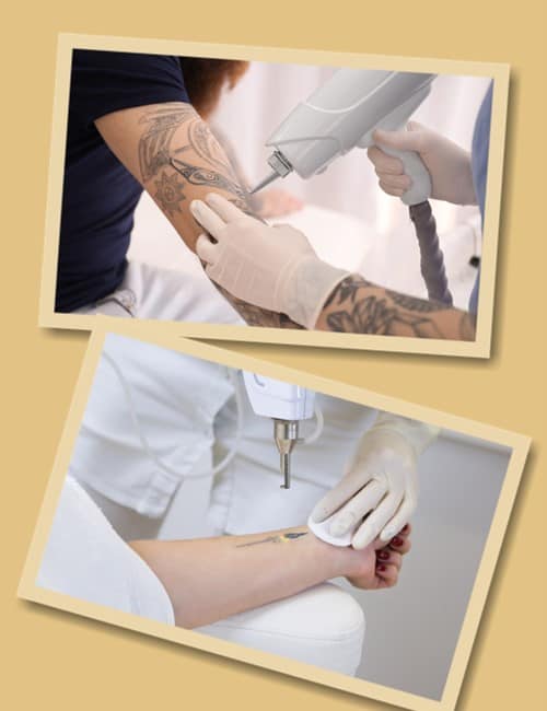 Виведення тату лазером