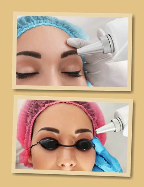 видалити татуаж брів