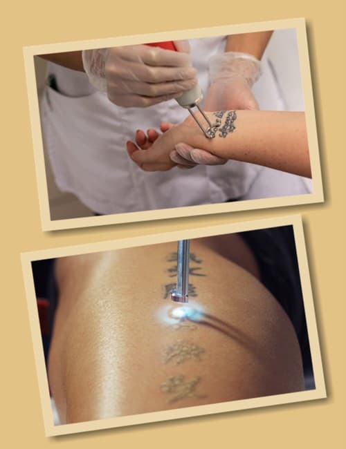 видалити наколку лазером