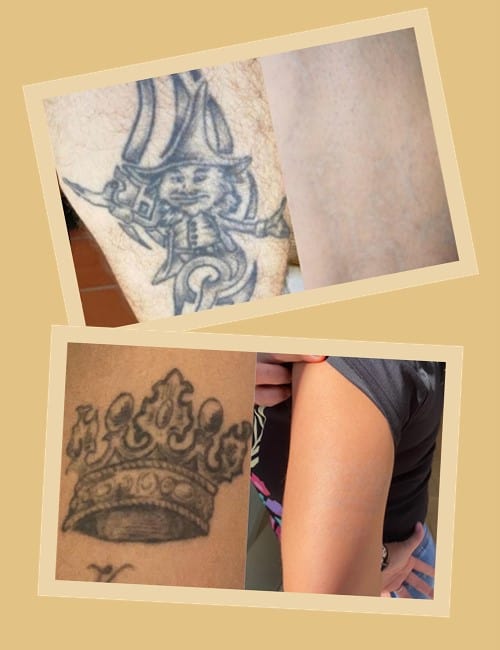 Переваги лазерного методу