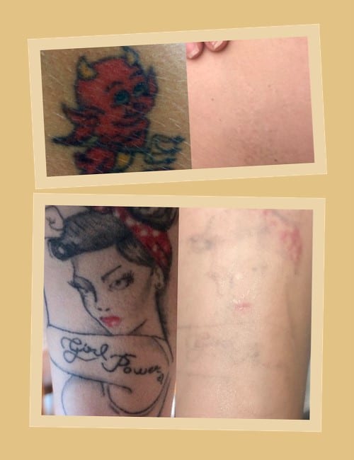 переваги лазерного методу