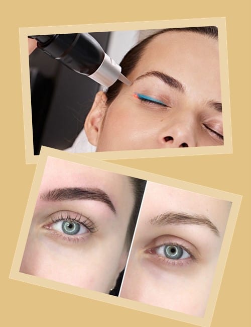 методи виведення татуажу