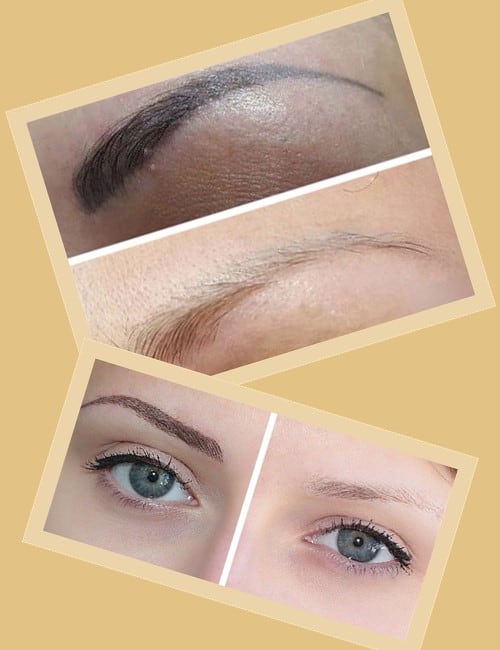 Видалити татуаж брів лазером в Києві