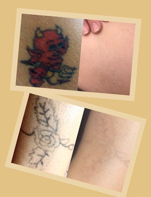 Як відбувається процедура?