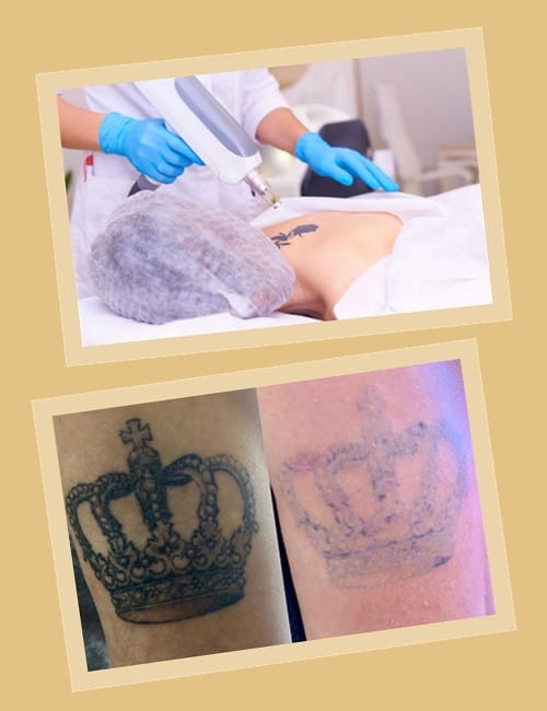 Вивести татуювання лазером без слідів