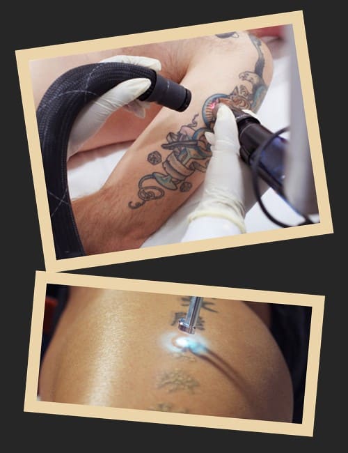 Якими методами видаляють татуювання