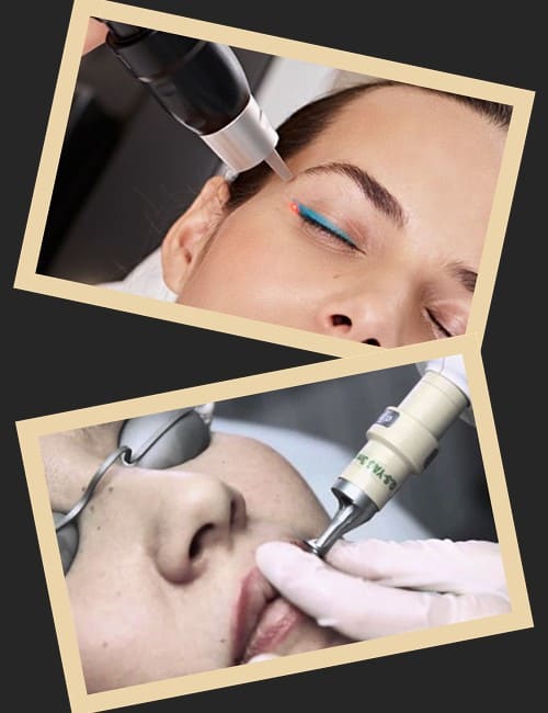 Зведення татуажу лазером