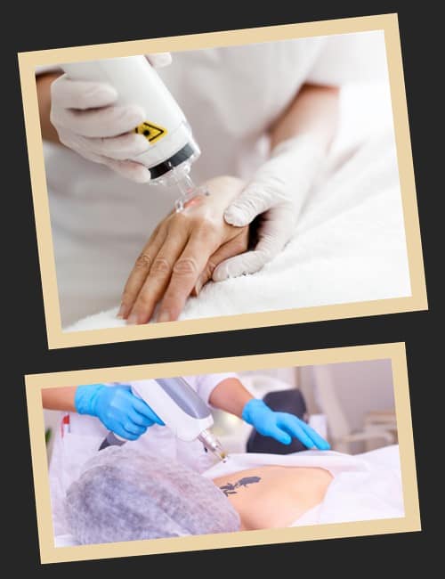 Лазерне видалення татуювань