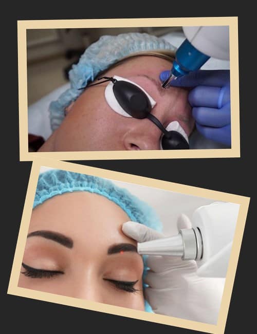 Видалення перманенту брів лазером