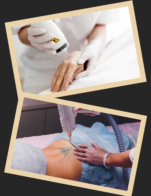 Видалення татуювань