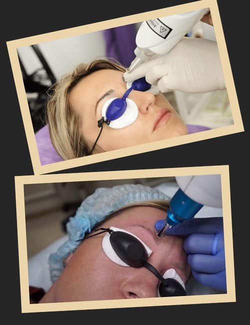 Лазерне видалення татуажу