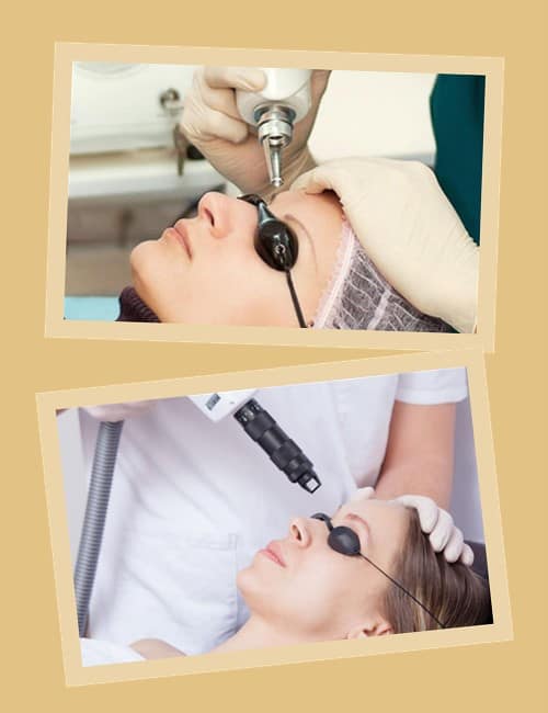 видалити татуаж брів лазером у Києві