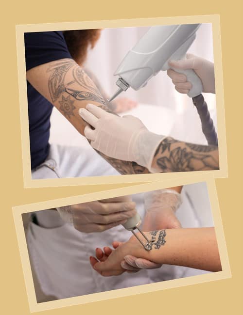 Як виводити татуювання лазером